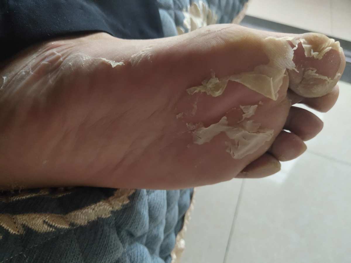 2. 使用抗真菌药物