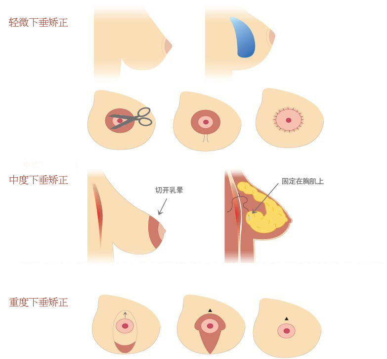 乳房悬吊术的疗效