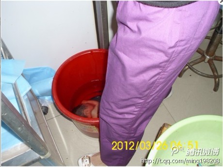 孕妇流产的预防