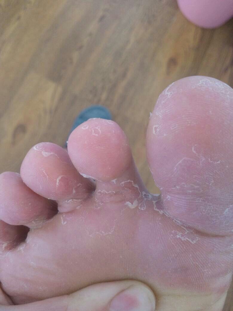 1.保持足部清洁干燥