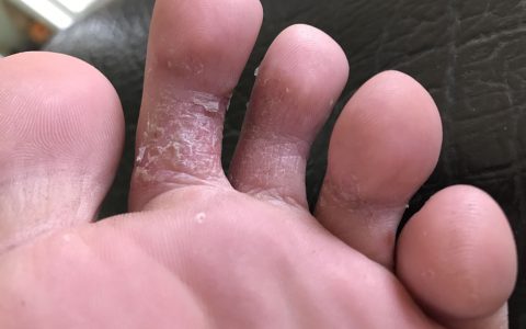 怎么判断是不是脚气？(脚气传染的相关症状)