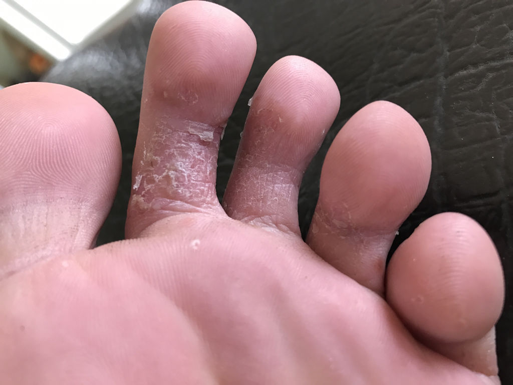 脚气传染的相关症状
