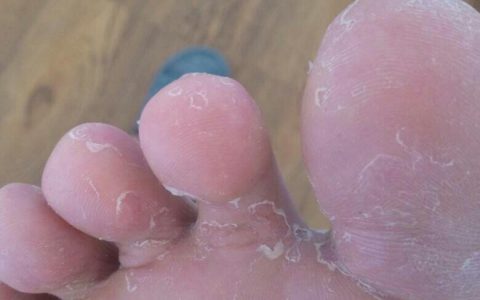 脚气用什么办法才能治好(脚气如何彻底治愈)